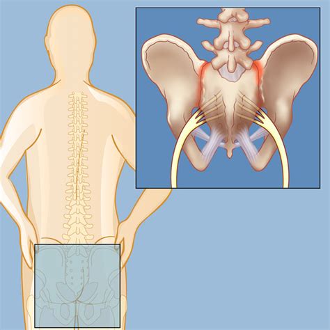 Sacroiliac Joint Dysfunction | Brain & Spine Center