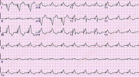 EKG JEOPARDY ! Jeopardy Template