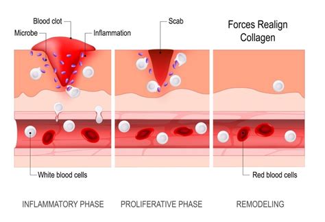 Does PRP Help Acute Sports Injuries Heal Faster? PRICE vs RICE - Regenexx