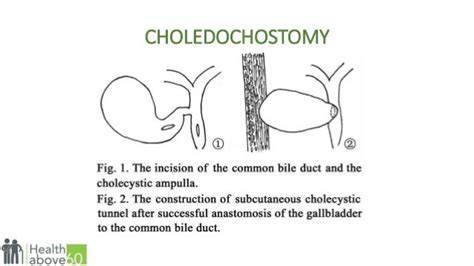 Anatomy of Cholelithiasis