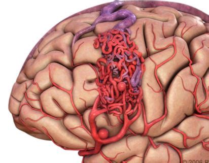 Arteriovenous Malformation - Pictures, What is?, Types, Causes