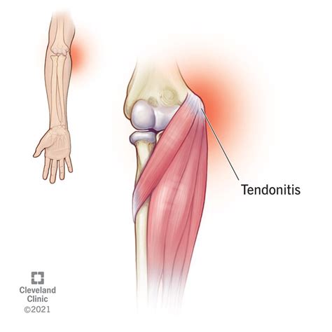 Golfer’s Elbow (Medial Epicondylitis): What Is It, Diagnosis & Treatment