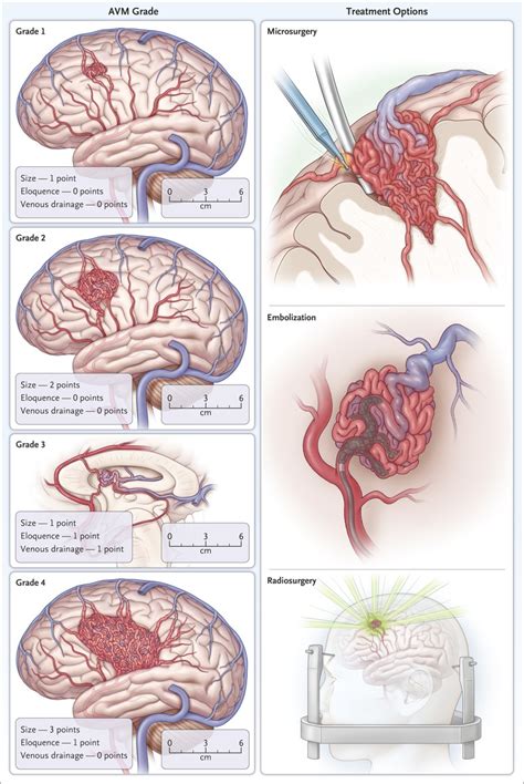 Arteriovenous Malformations of the Brain | NEJM