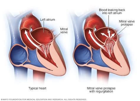 Mitral valve regurgitation - Symptoms and causes - Mayo Clinic