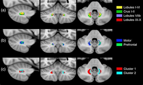 Dentate Nucleus Mri