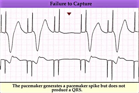 Pacemaker failure to capture - marquette | Eccles Health Sciences ...