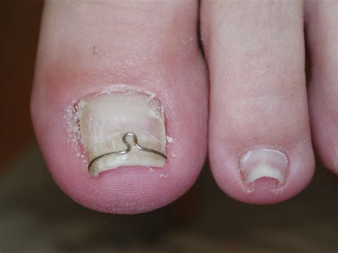 Ingrowing toenail correction with surgery & bracing | Foot Fix Clinic