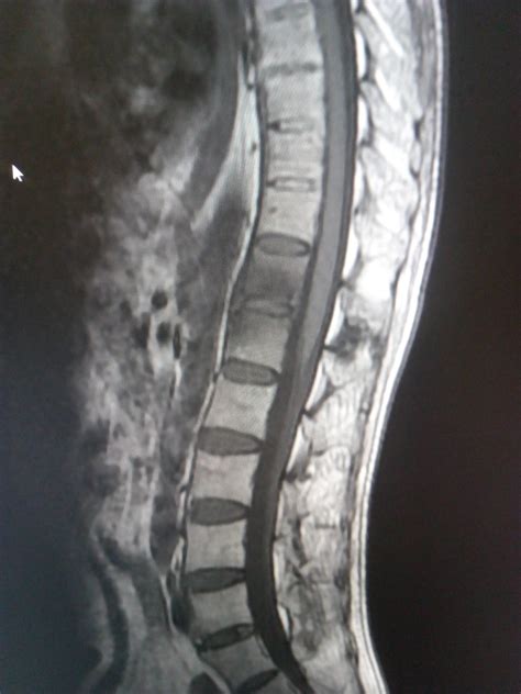 Ankylosing Spondylitis: MRI - Sumer's Radiology Blog