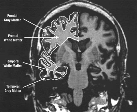 Age-Related Changes in Frontal and Temporal Lobe Volumes in Men: A ...