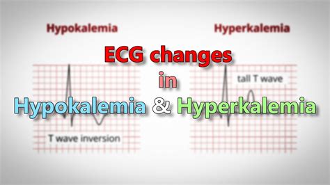 ECG Waveform Explained PDF: EKG Labeled Diagrams, Components, Waves ...