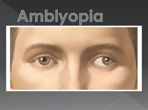 Amblyopia