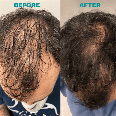 PRP for Hair Loss | Ventura, Ventura County CA | Bloom Med Spa