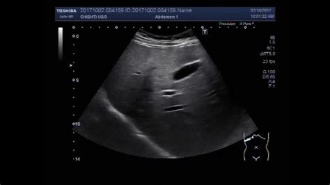 Gallbladder Hydrops Ultrasound