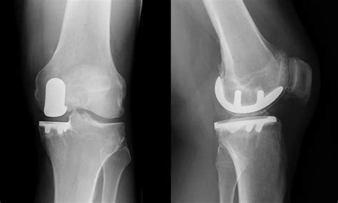 Unicompartmental or Partial Knee Replacement | Proliance Orthopedic