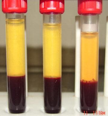 Separating plasma and buffy coat. | Download Scientific Diagram