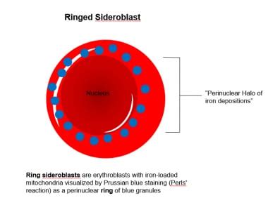 Sideroblastic Anemias: Practice Essentials, Pathophysiology, Etiology