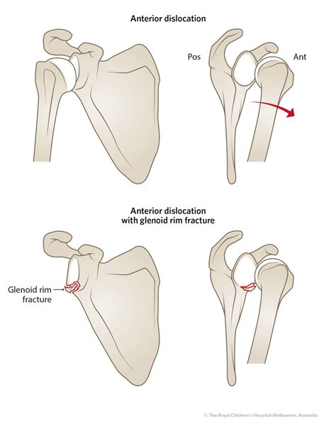 Clinical Practice Guidelines : Shoulder Dislocations - Emergency Department