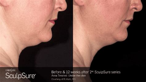 SculpSure Before and After - Nashville, TN