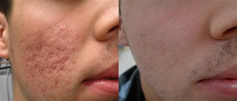 Fractional Laser Before And After, Laser Facial Before And After Emerge ...