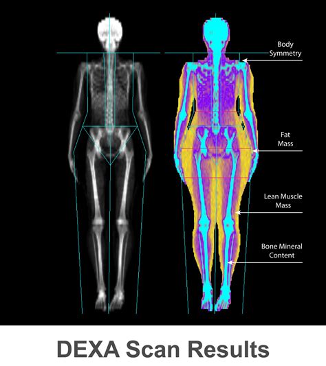 Dexa Body Composition Scan - DEXA at Accurate Imaging Diagnostics