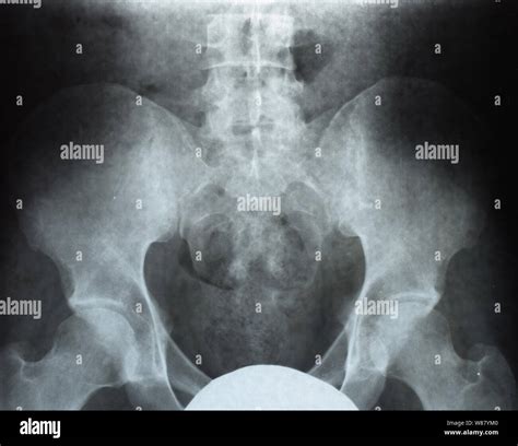 X-ray of the pelvis and sacrum. X-ray image Stock Photo - Alamy