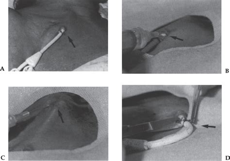 Catheter and Port Removal: Techniques and Follow-Up Care | Thoracic Key