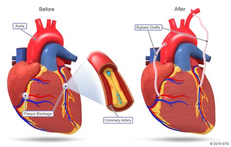 Coronary Artery Bypass Grafting - Newport Cardiac & Thoracic Surgery