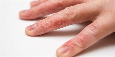 Hand Eczema: 8 Ways to Deal With This Frustrating Condition | SELF