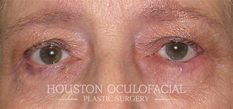 Entropion Repair Before & After | Houston Oculofacial Plastic Surgery