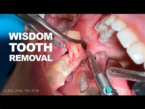 Removed Wisdom Teeth | www.pixshark.com - Images Galleries With A Bite!