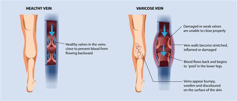 What are Varicose Veins–Causes,Symptoms,Treatment|HEAVYLEGS.IN