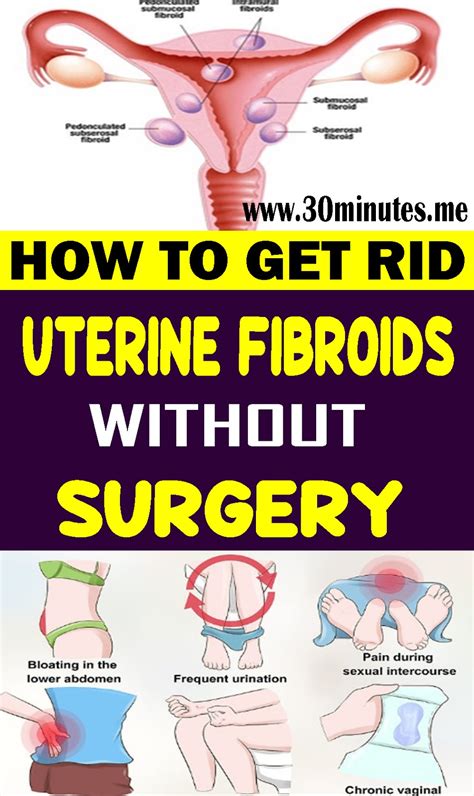 How to Get Rid of Uterine Fibroids without Surgery