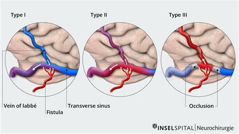 Dural Arteriovenous Fistula Classification Download Scientific Diagram ...