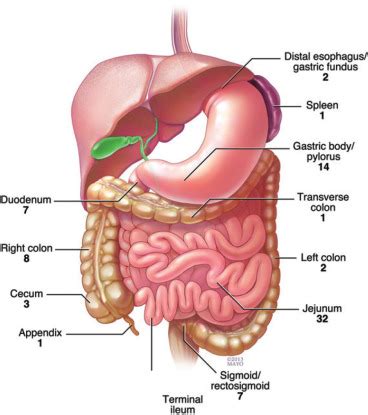 Bowel perforation in intestinal lymphoma: incidence and clinical ...