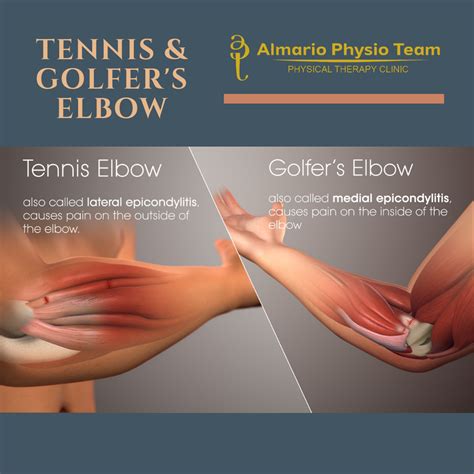 CASECON: Tennis Elbow (Lateral Epicondylitis) & Golfer's Elbow (Medial ...