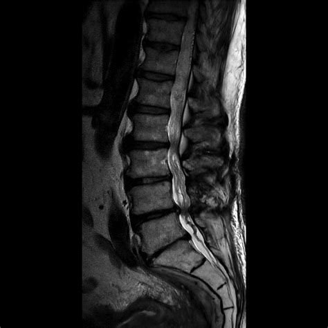 Lumbosacral Spine MRI | Radiology Key