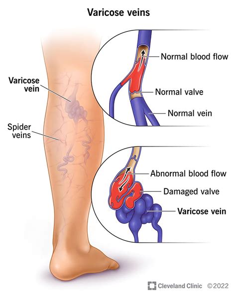 Varicose Veins: Causes & Treatment