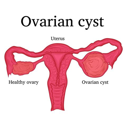 Is It an Ovarian Cyst or a Fibroid? - Cherokee Women's Health