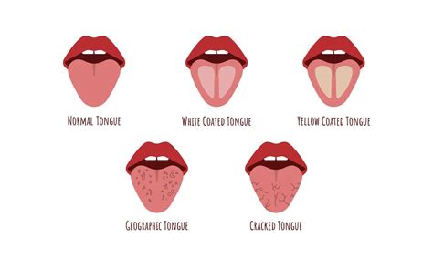 Tongue problems. White Yellow coated, Cranched, Geographic tongue. Oral ...