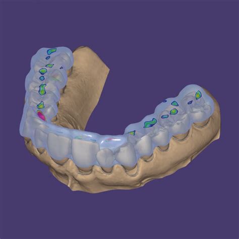 Bite Splint Module