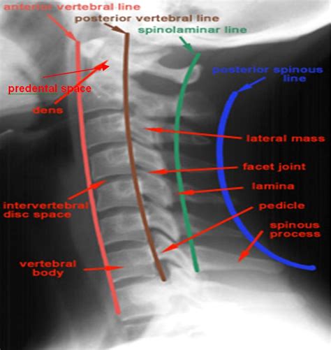 X-ray Skills 2: Cervical Spine X-ray Interpretation in 2023 | Medical ...