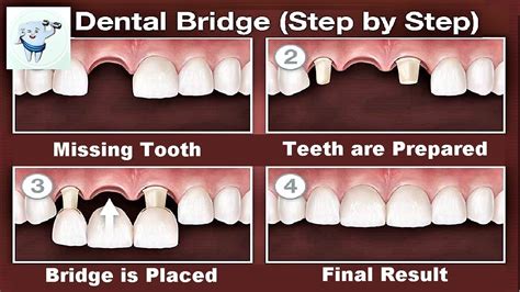 Dental Bridge Procedure