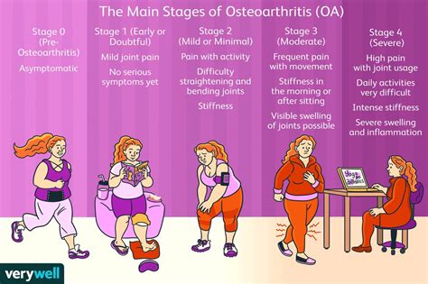 The Stages of Osteoarthritis