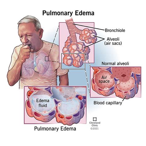 Pulmonary Edema Signs And Symptoms