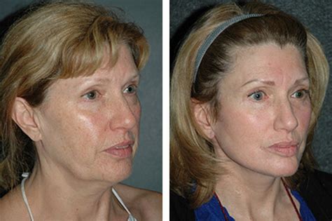 Lower Facelift New York | Lower Facelift and Necklift