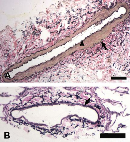 Pulmonary artery and vein histological confirmation postmyography ...