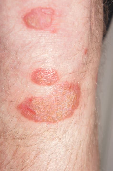 Psoriasis Pictures - View Free Images of Psoriasis