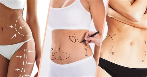 Liposuction Vs CoolSculpting: Which Is Right For You?