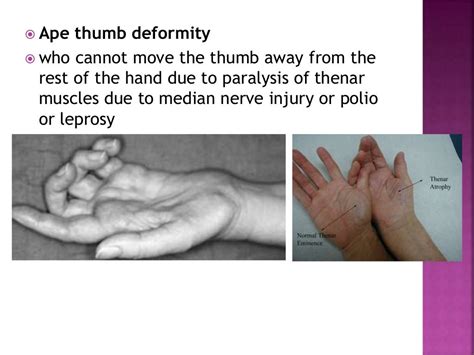 Ape thumb deformity to publish