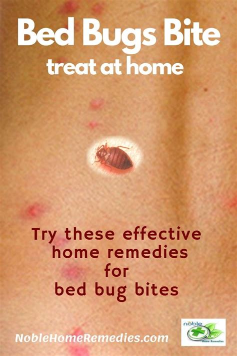 10 Effective Bed Bug Bites Home Remedies and Preventions | Bug bites ...